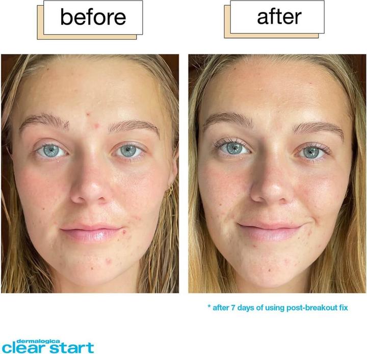 Produktbild Dermalogica Clear Start - Post-Breakout Fix (Körpercreme, 15 ml)