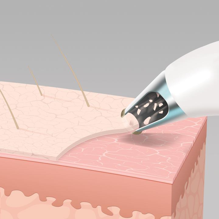 Actual product image Homedics MD-1000 Remove