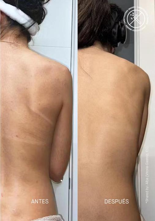 Produktbild Acnemy Zitback (Körperlotion, 80 ml)