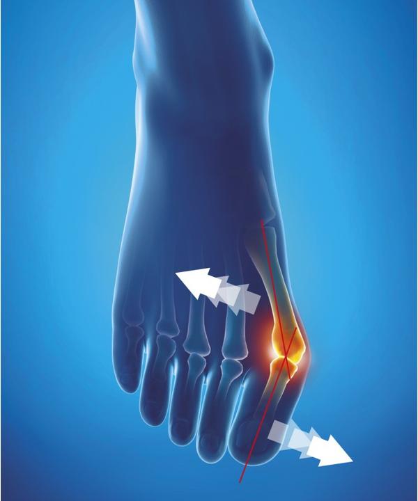 Actual product image Epitact flexible correction bandage hallux valgus TAG L 23-24.5cm (L)