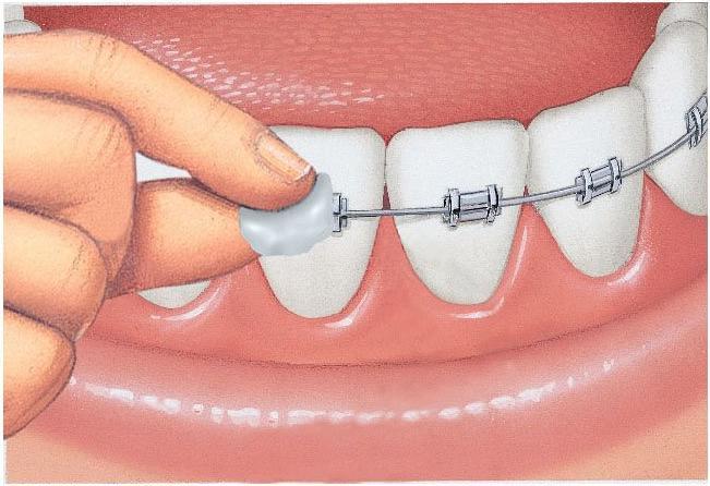 Immagine prodotto GUM SUNSTAR Orthodontic Wachs