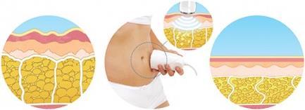 Image du produit Homedics Ultraslim Pro USL-1000-UE