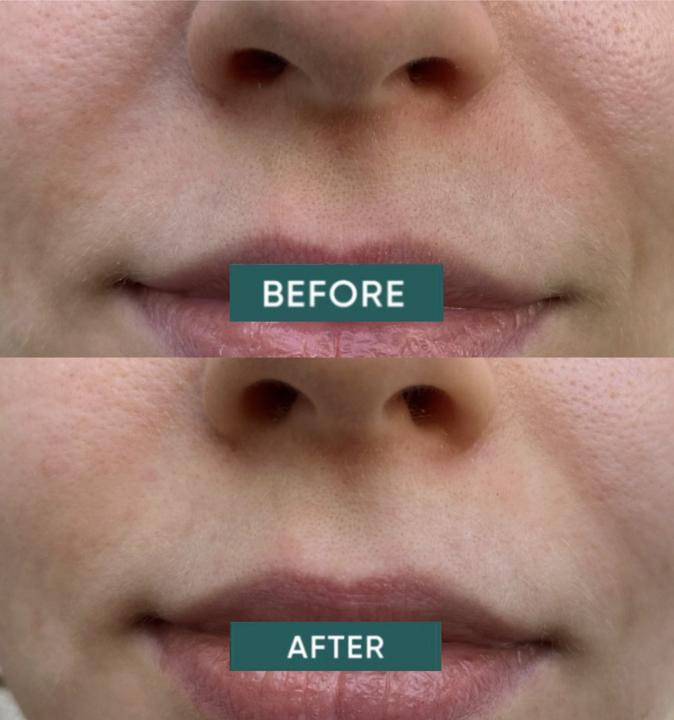 Actual product image Apricot Mundpflaster keep smiling 100 (100 x)