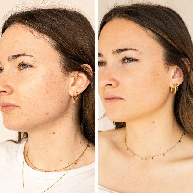 Actual product image Endro Cosmétiques Serum natürlich gegen Unreinheiten 30 ml (30 ml)