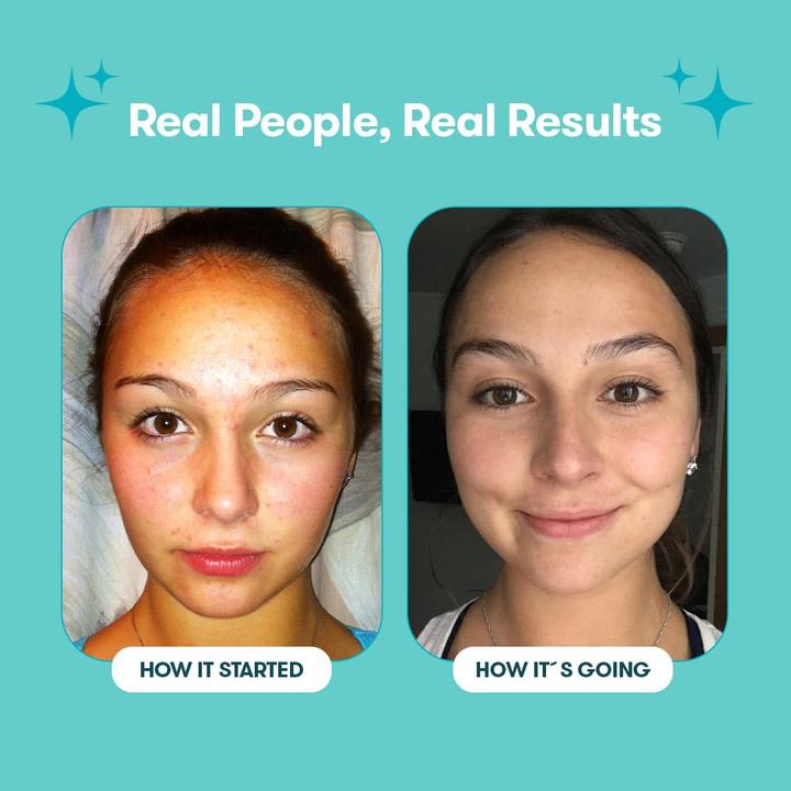 Produktbild Proactiv Solution 30 Tage Kit 150 ml + Zits Happen Patches (Reinigungstücher Gesicht, 150 ml)