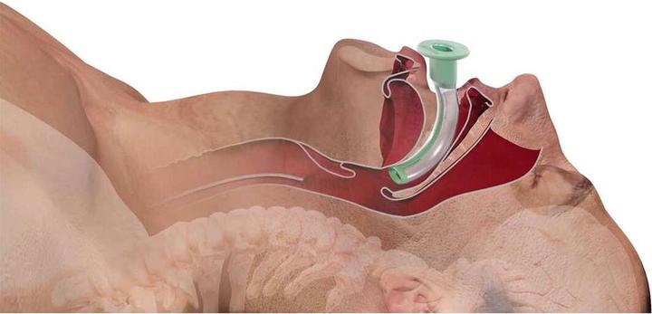 Intersurgical Einmal-Guedel-Tubus Gr.0, grau, ISO 5.5
