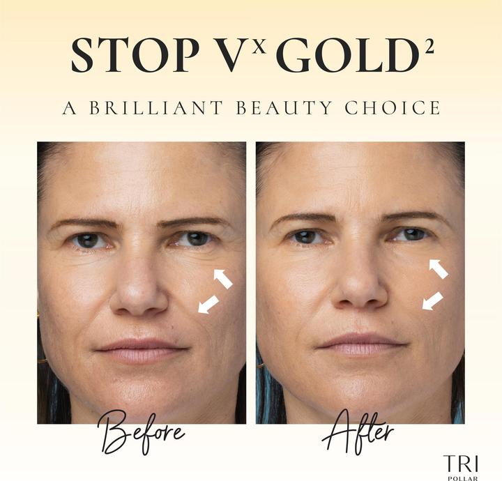 Actual product image TriPollar VX Gold2 ultimate skin care anti ageing RF-DMA