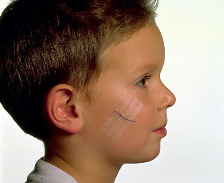 Produktbild Nexcare Steri-Strip Wundverschlussstreifen (6 x)