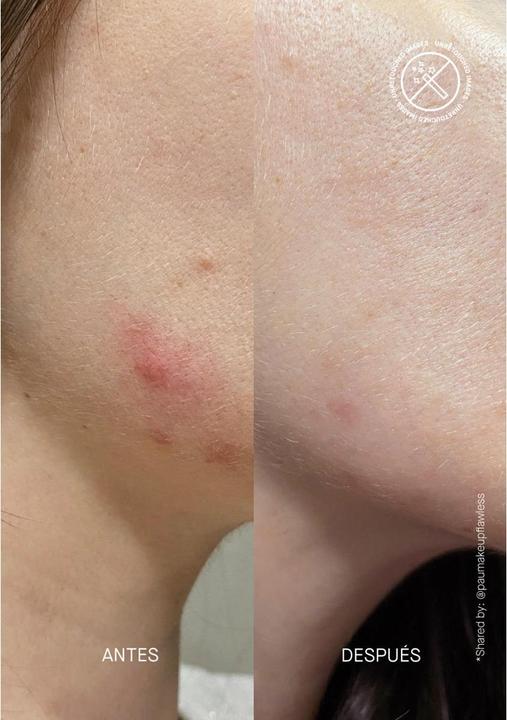 Immagine prodotto Acnemy Siero correttore POSTZIT (30 ml)