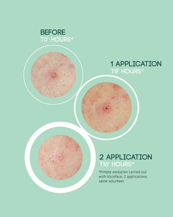 Produktbild Iroha Nature Nature SOS Pimple Patches (19.80 ml)