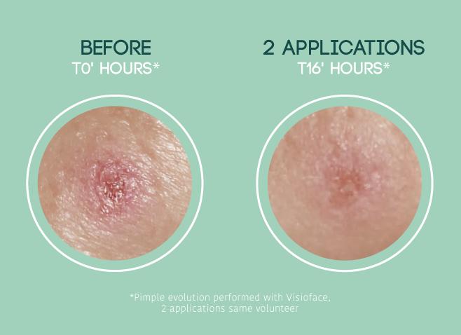 Produktbild Iroha Nature Nature SOS Pimple Patches (19.80 ml)