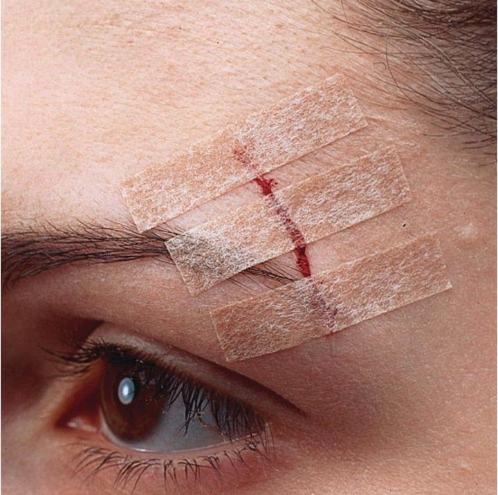 Produktbild Nexcare Steri-Strip Wundverschlussstreifen (6 x)