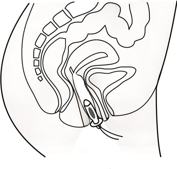 Image du produit Promed IT-6 Appareil de traitement de l'incontinence, y compris sonde vaginale (1 x)