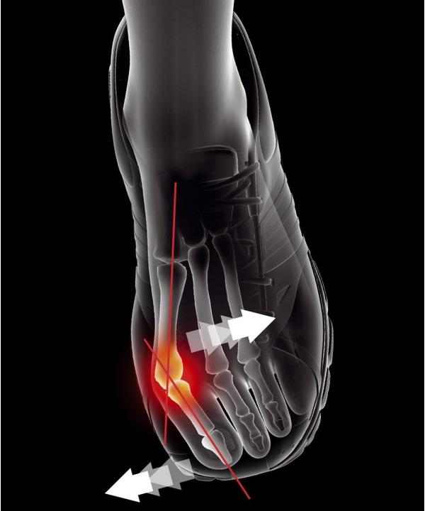 Produktbild Epitact Sport Hallux Valgus Orthese EpitheliumFlex 02, Gr. L (L)